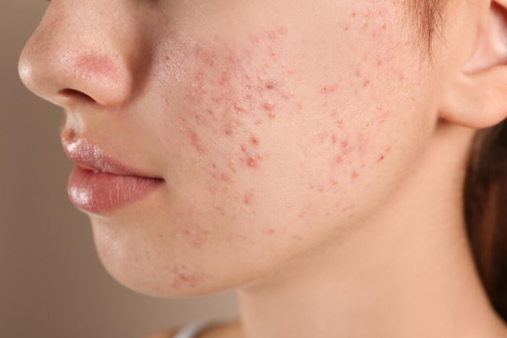 Benefits of UVB for Acne Treatment