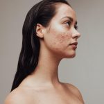 Do Thyroid Issues Lead to Acne? The Myths About Thyroid Pimples