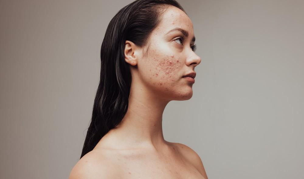 Do Thyroid Issues Lead to Acne? The Myths About Thyroid Pimples