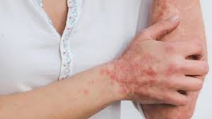 10 Myths About Psoriasis: Full Guide