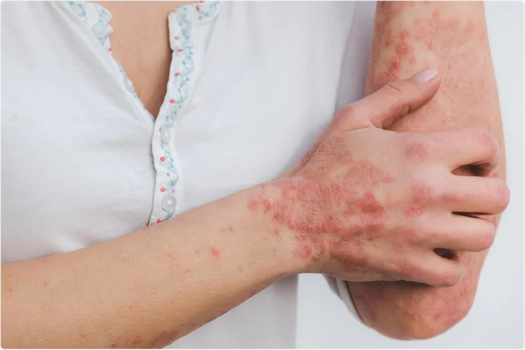 10 Myths About Psoriasis: Full Guide