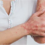 10 Myths About Psoriasis: Full Guide