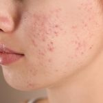 Classifying and Managing Acne Vulgaris