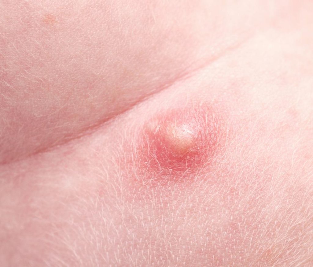 Understanding Scrotal Dermatitis: Full Guide