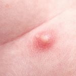 Understanding Scrotal Dermatitis: Full Guide