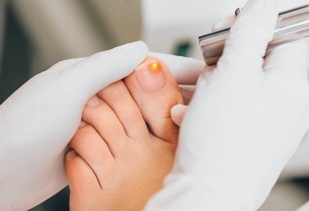 UV Light and Its Effects on Nail Fungus