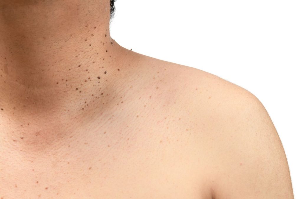 What’s the Difference Between Seborrheic Keratosis and Actinic Keratosis?