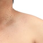 What’s the Difference Between Seborrheic Keratosis and Actinic Keratosis?